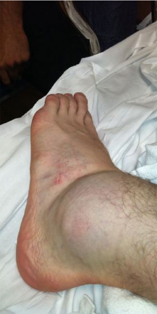 Brad Keselowski’s ankle after the testing accident at Road Atlanta.